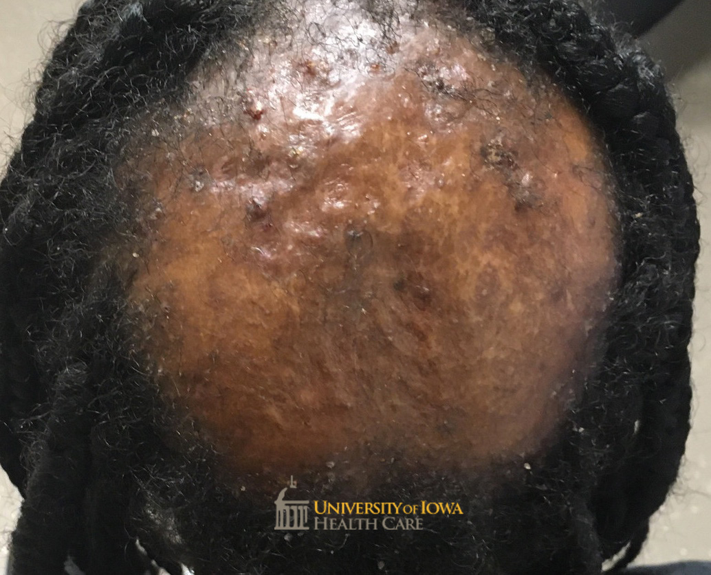 Patch of scarring alopecia with boggy papules and pustules and scaling at the periphery. (click images for higher resolution).
